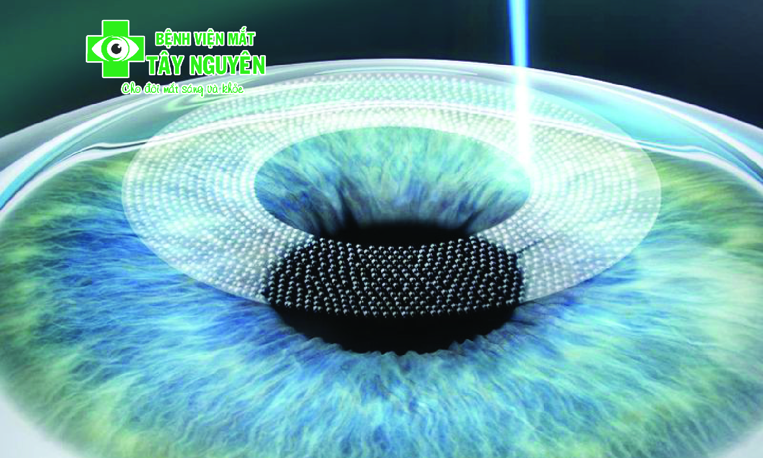 FEMTO LASIK PHƯƠNG PHÁP ĐIỀU TRỊ TẬT KHÚC XẠ AN TOÀN, CHÍNH XÁC